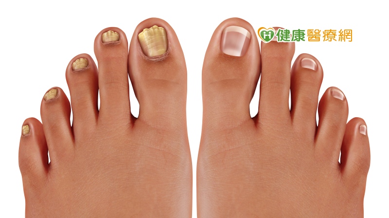 指甲變色就是灰指甲?　醫生解析怎麼治療