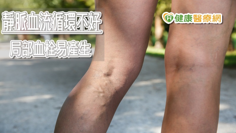 小腿痠痛癢不能輕忽　女性靜脈曲張竟比男性高4倍！_音波拉皮