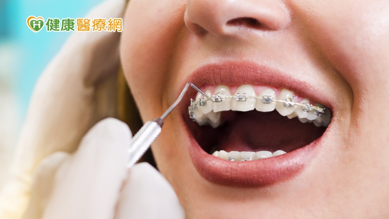 牙齒矯正後卻跑位？　１小動作恐讓前功盡棄_Thermage FLX,鳳凰電波