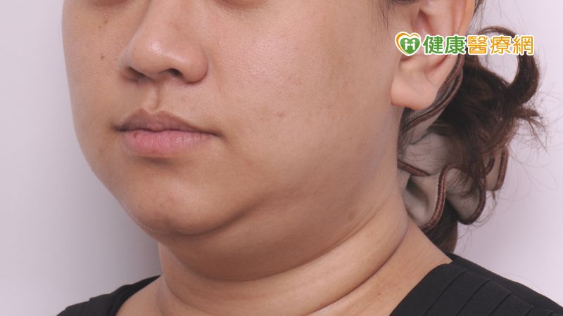 常低頭滑手機會雙下巴？　皮膚科醫師這樣說_Thermage FLX,鳳凰電波