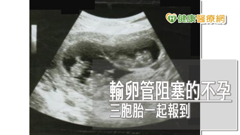 試管嬰兒三胞胎　懷孕過程有驚無險_音波拉皮